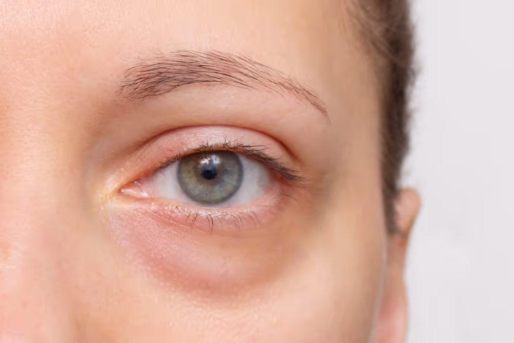 Green eye with slight redness and swelling