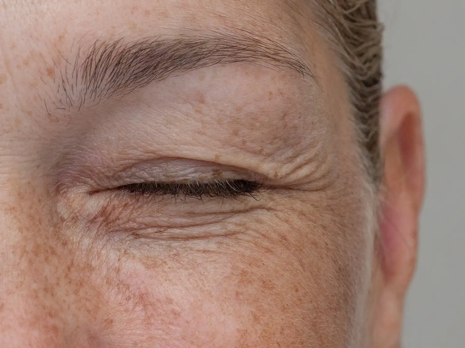 Close-up of woman with eye condition