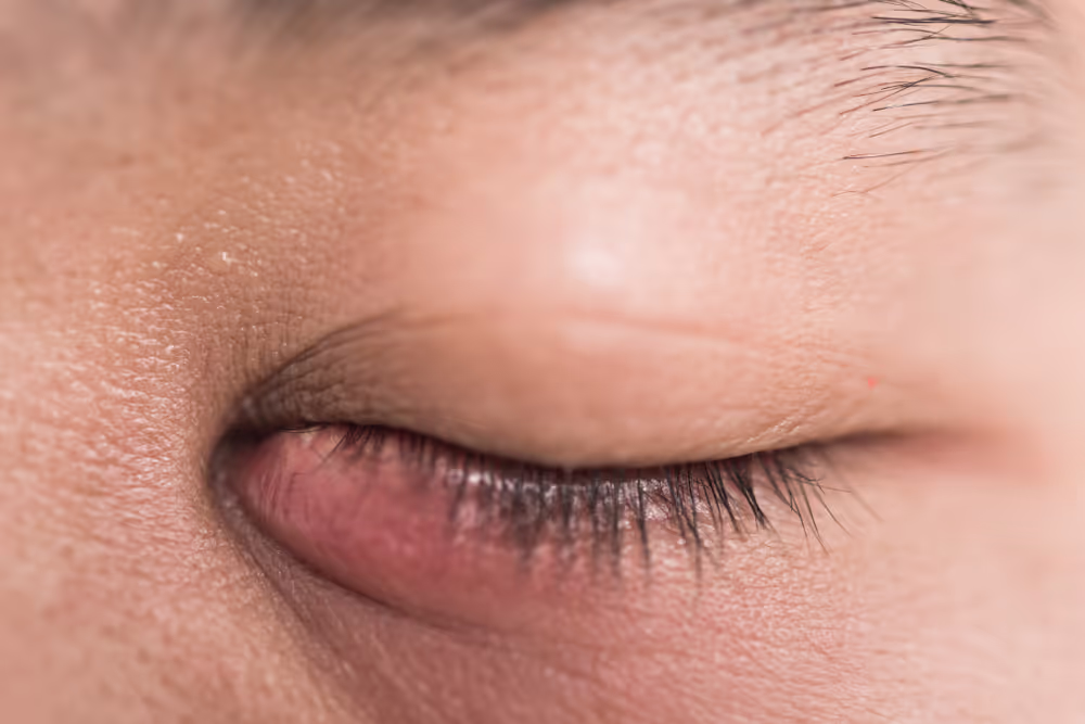 Swollen lower eyelid with redness