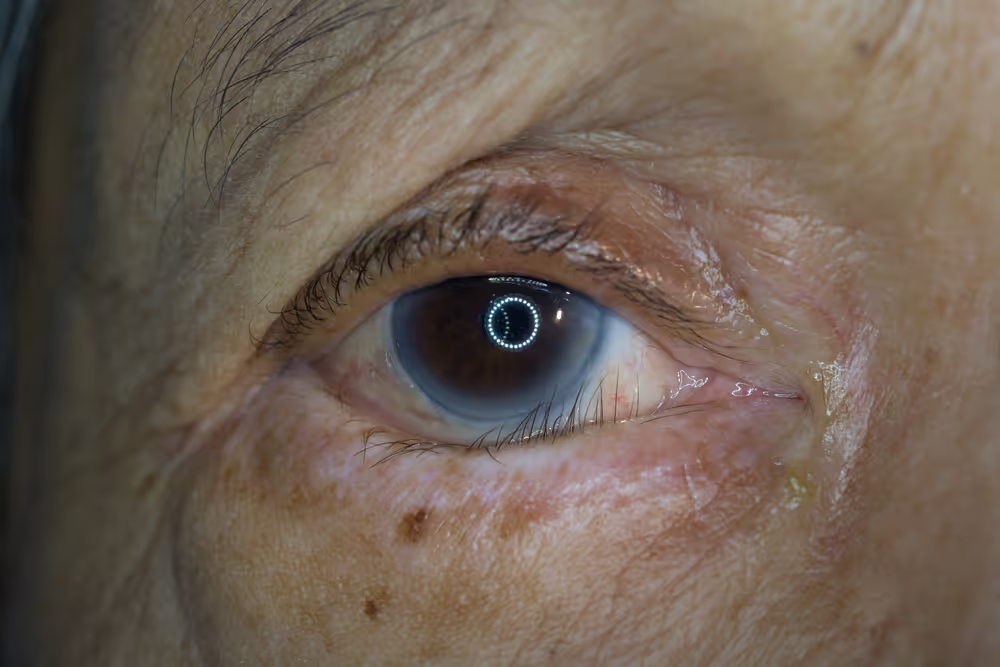 Close-up of eye with corneal condition