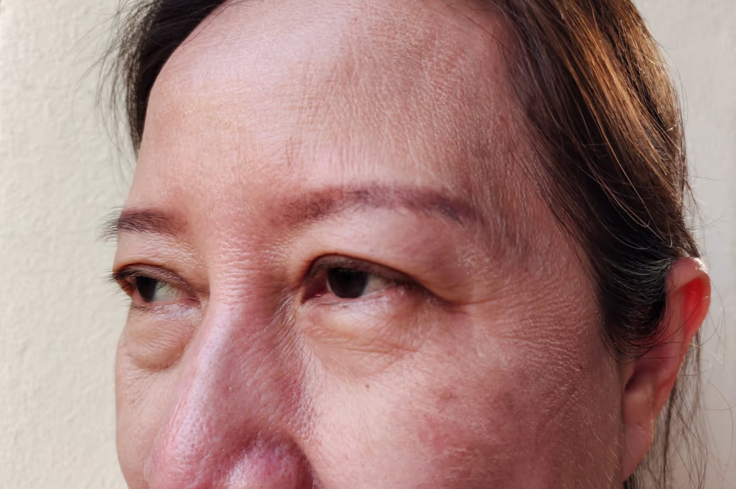 Close-up of woman with eye condition
