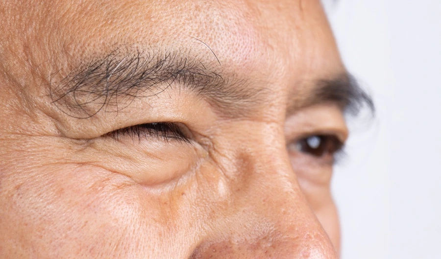 Eyelid Malposition