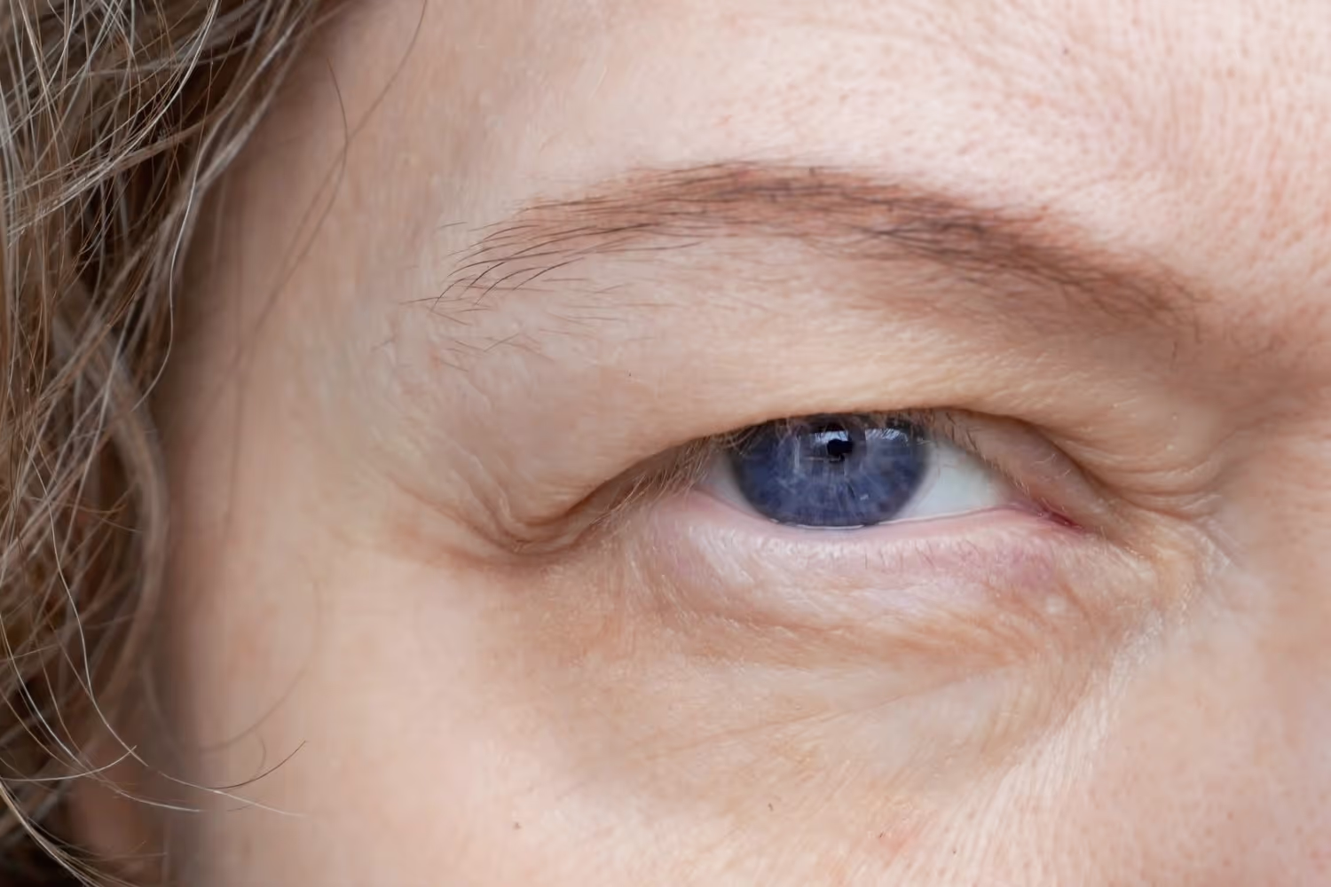 Close-up of eyelid with medical condition